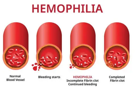 Haemophilia